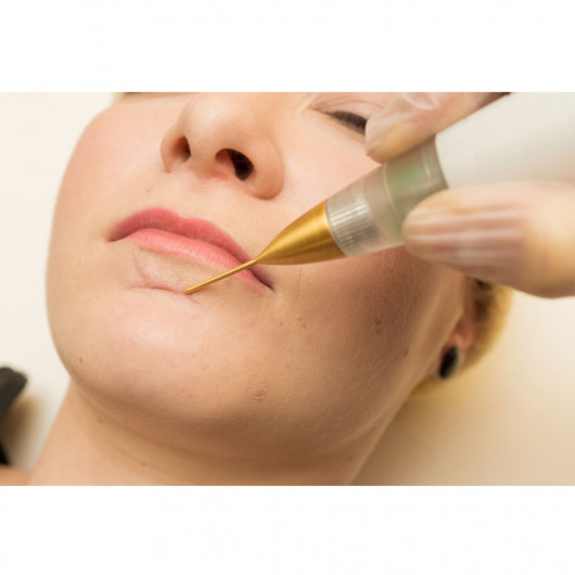 Jett Plasma Lift Medical- Lifting Corporal e Facial, intervenções dermatológicas e pequenas cirurgias Celebrim - 9