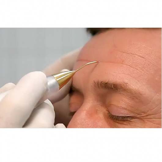 Jett Plasma Lift Medical- Lifting Corporal e Facial, intervenções dermatológicas e pequenas cirurgias Celebrim - 5