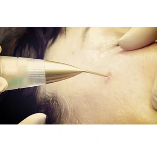 Jett Plasma Lift Medical- Lifting Corporal e Facial, intervenções dermatológicas e pequenas cirurgias Celebrim - 6