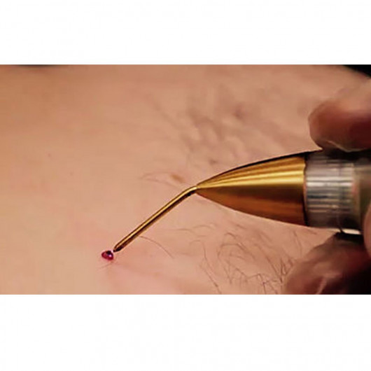 Jett Plasma Lift Medical- Lifting Corporal e Facial, intervenções dermatológicas e pequenas cirurgias Celebrim - 7