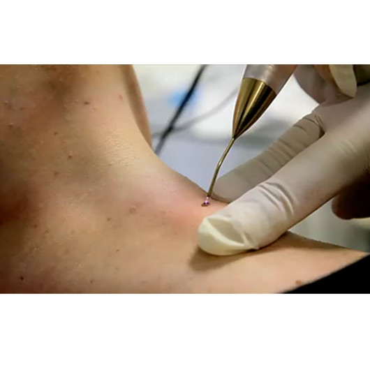 Jett Plasma Lift Medical- Lifting Corporal e Facial, intervenções dermatológicas e pequenas cirurgias Celebrim - 4